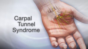Read more about the article Carpal Tunnel Syndrome – Why Is It So Bad at Night?
